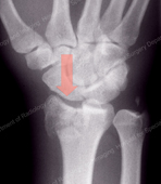 Compression Fracture of the Distal Radius