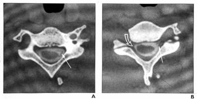 CT myelogram showing a normal brachial plexus (left) and injured brachial plexus (right)