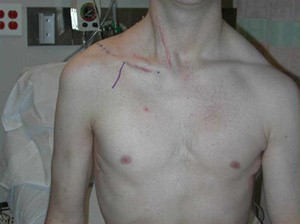 A Patient Before Brachial Plexus Repair with Markings Showing the Site of Surgery.