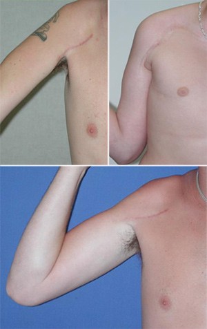 Examples of Postsurgical Scarring after Brachial Plexus Repair