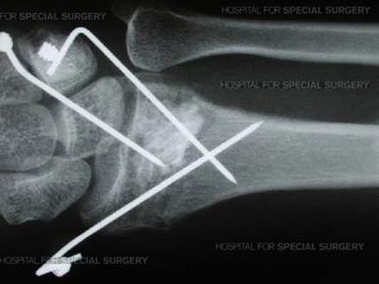 Arthroscopic Surgery