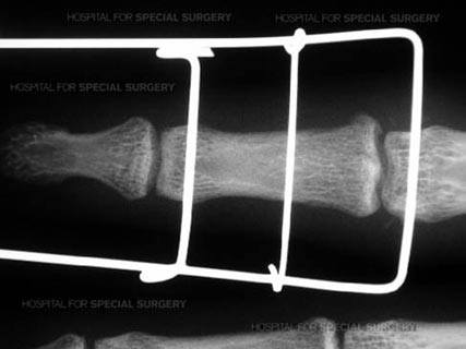 Other fractures