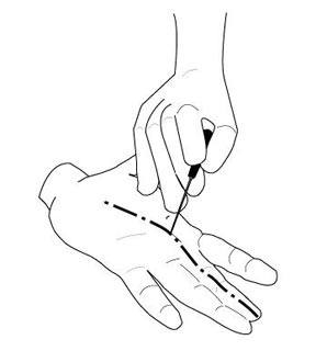 Percutaneous Soft Tissue Procedures
