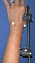 Example of External (percutaneous) Fixator for Distal Radius Fracture