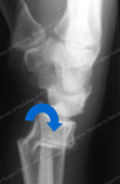 Colles' (dorsal) Fractures are caused by bending of the bone when the hand is extended backward on the wrist