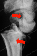 Shearing of a Distal Radius Fracture of the Wrist