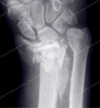 Complex Fracture of the Distal Radius