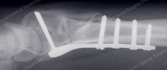 Interal Fixation of a Distal Radius Fracture
