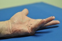 Figure 1A-B. Stage II disease, recognized by an MPJ cord contracting the middle finger but sparing the PIP joint.