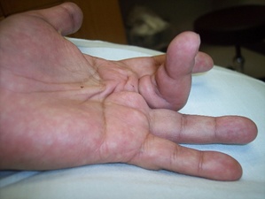 Figure 2. Stage III disease; note the contracture of the MPJ and PIP joints.