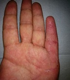 Figure 2. Stage III disease; note the contracture of the MPJ and PIP joints.
