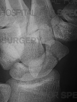 An Acute Scaphoid Fracture