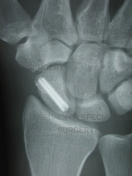 Successful internal fixation of a scaphoid fracture, which has essentially healed.