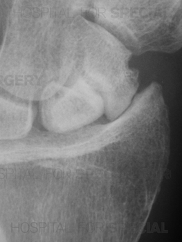 This image shows a chronic scaphoid fracture nonunion with osteoarthritic changes apparent in the adjacent joint.