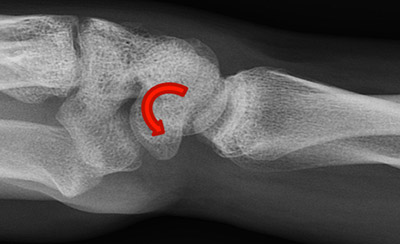 Scapholunate Ligament Injuries