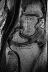 Scapholunate Ligament Injuries