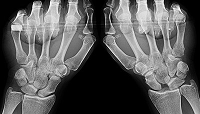 Scapholunate Ligament Injuries