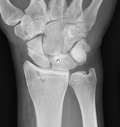 Scapholunate Ligament Injuries