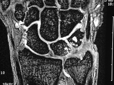 Ulnar Impaction Syndrome Section